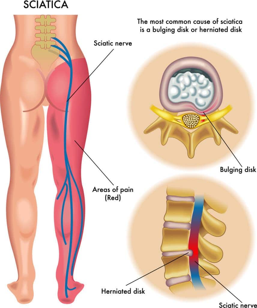 sciatica